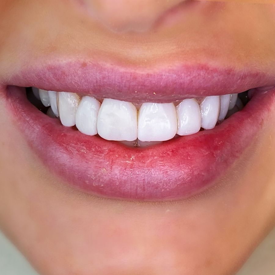 composite bonding - after - 3Dental - Dublin & Limerick